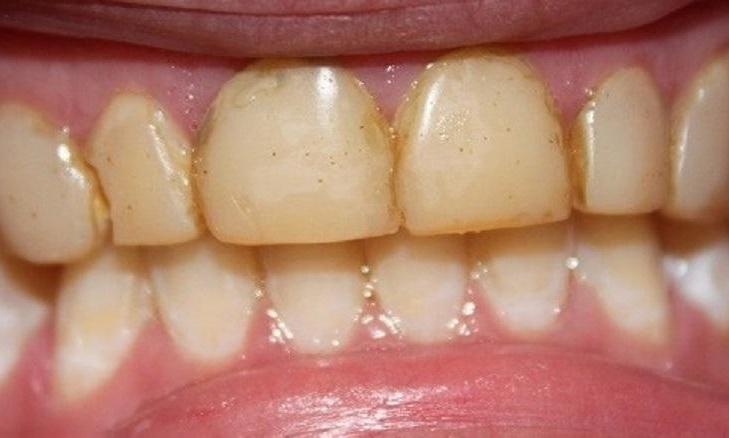 teeth before veneers from our vienna office | cosmetic dentist in vienna