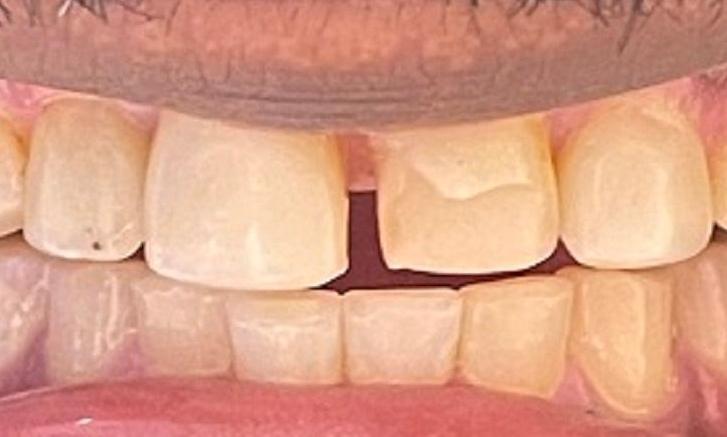 teeth before veneers at our vienna office 