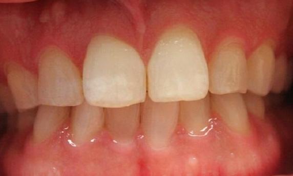 teeth before a Zoom! teeth whitening treatment | teeth whitening vienna va