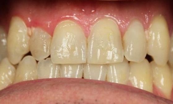 teeth prior to a zoom in-office whitening treatment | in-office teeth whitening vienna va