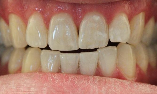 teeth prior to an in-office whitening treatment | professional teeth whitening vienna va