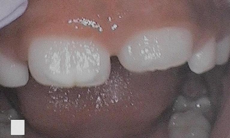 Operculectomy-For-Permanent-Tooth-Eruption-After-Image