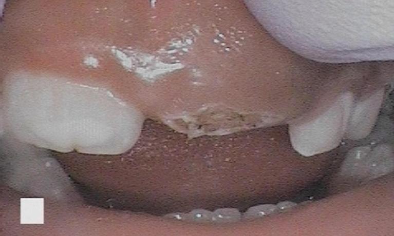 Operculectomy-For-Permanent-Tooth-Eruption-Before-Image