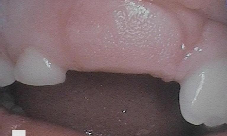 Operculectomy-For-Permanent-Tooth-Eruption-Before-Image