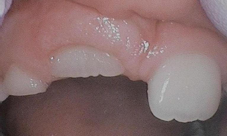 Operculectomy-For-Permanent-Tooth-Eruption-After-Image