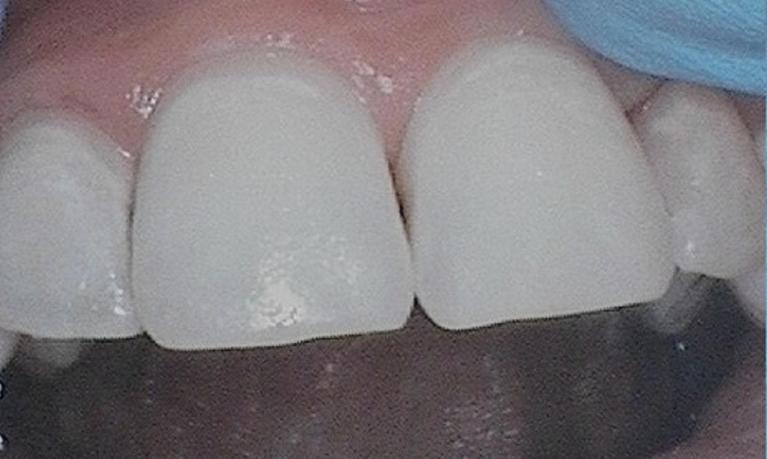 teeth after getting discoloration removed post-orthodontics | dentist vienna va