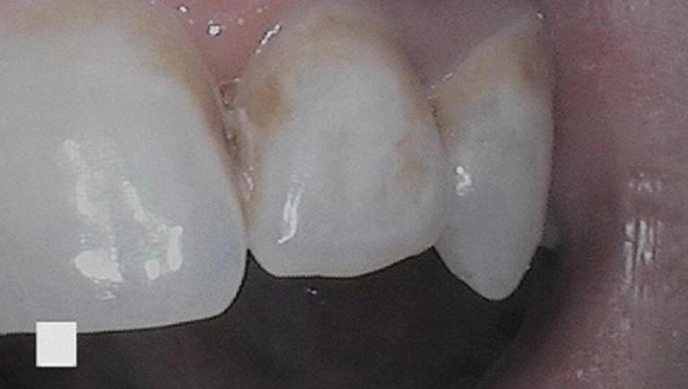 discoloration left on a patients teeth from orthodontic treatment | dentist vienna va