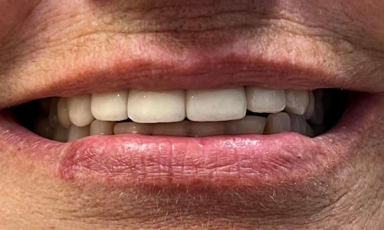 Restored-Smile-Using-Implants-After-Image