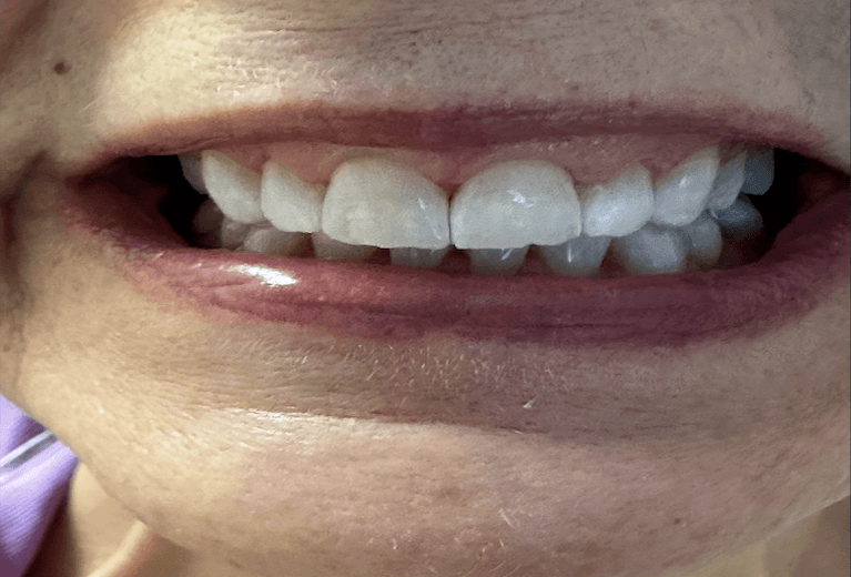 K-R-ULTRA-T-Whitening-System-After-Image