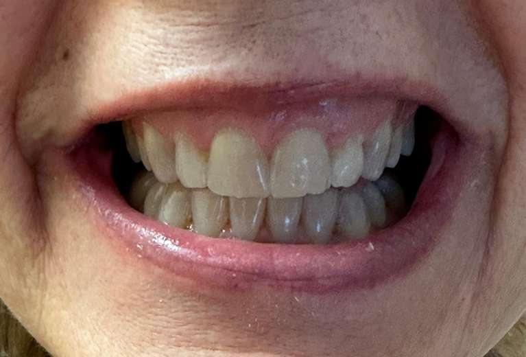K-R-ULTRA-T-Whitening-System-Before-Image