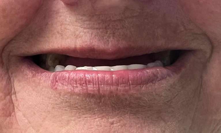 Restored-Smile-Using-Implants-Before-Image